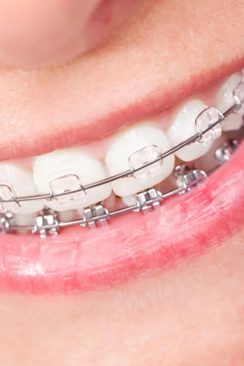 Darstellung der Behandlungsmethode einer festsitzenden Klammer für die dauerhafte Korrektur der Zahnfehlstellung in der Praxis für Kieferorthopädie Dr. Thurn an den Standorten Düren und Kreuzau.